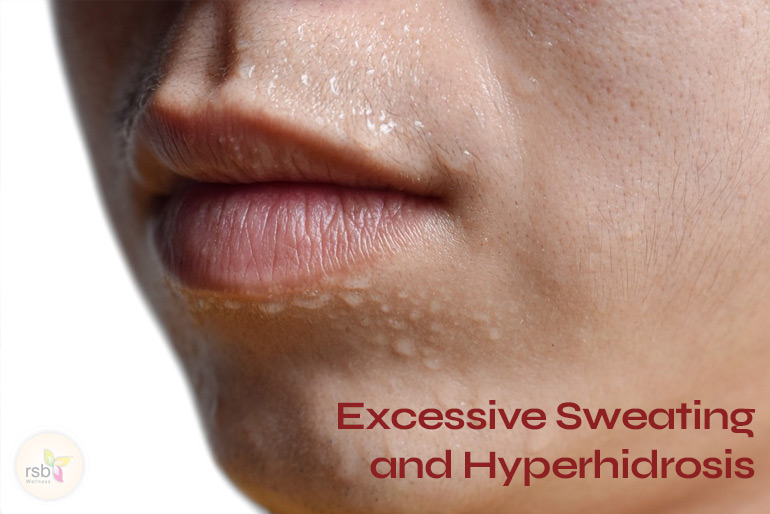 excessive sweating treatment at RSB Wellness