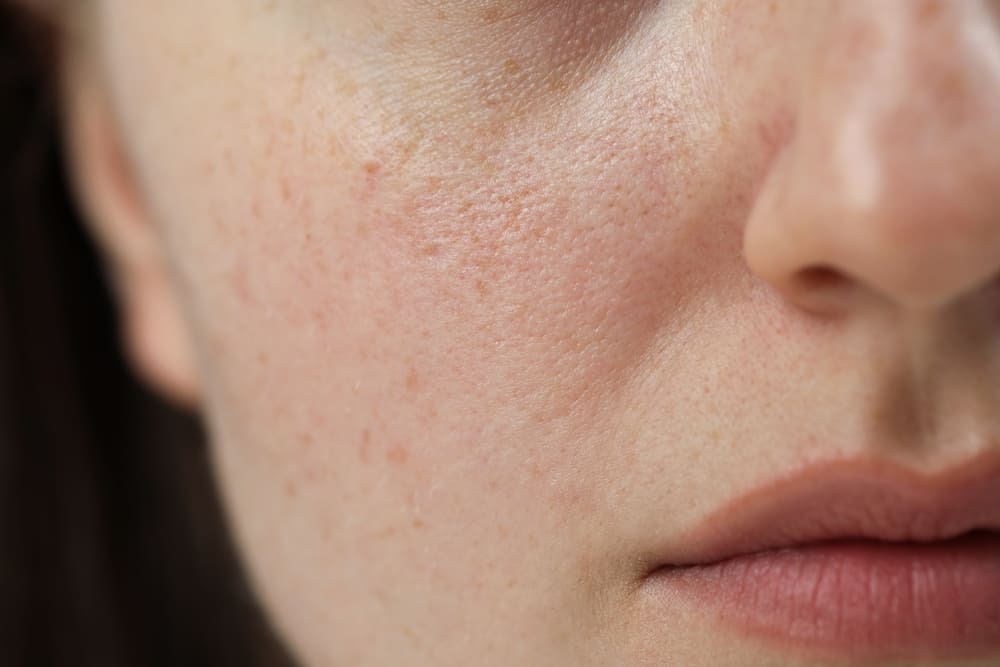 facial dry skin in winter
