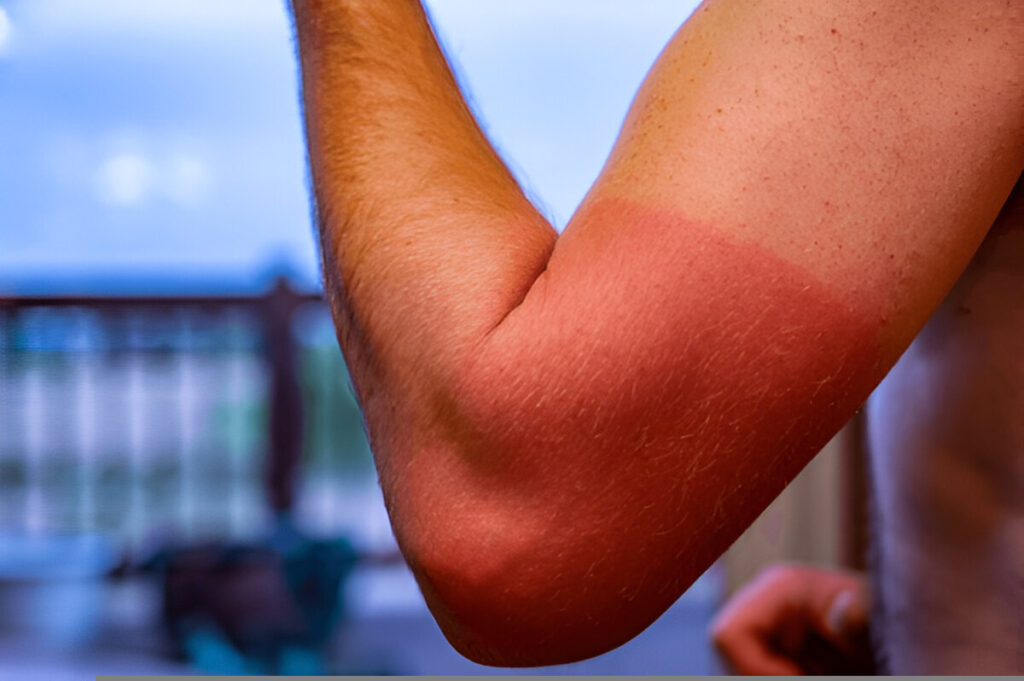 Skin Tanning, How to Remove Tan From Body