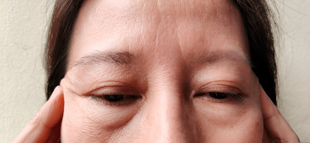 Eyebrow hair loss