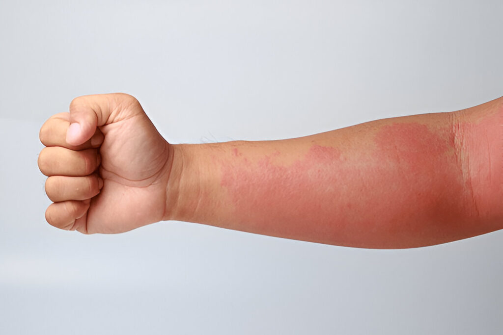 Sun Burn, how to remove tan from body