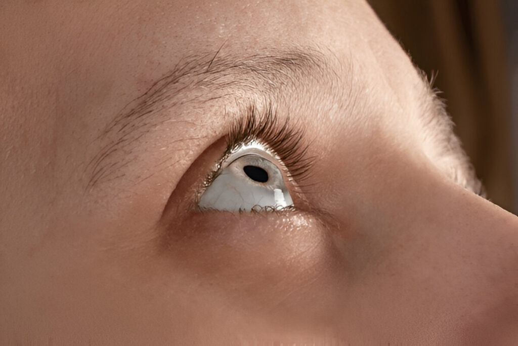 Thinning Eyebrow, Can Iron Deficiency Cause Eyebrow Hair Loss?