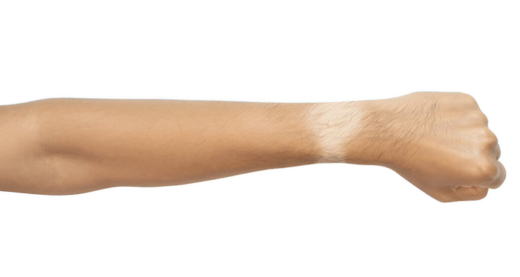 Skin Tanning, What is the Reason for Skin Tanning?