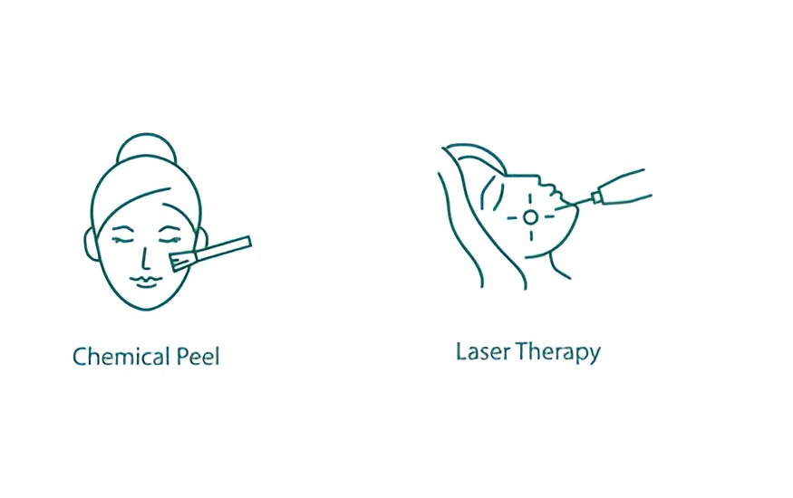 Chemical Peel Vs Laser, chemical peel treatment for hyperpigmentation
