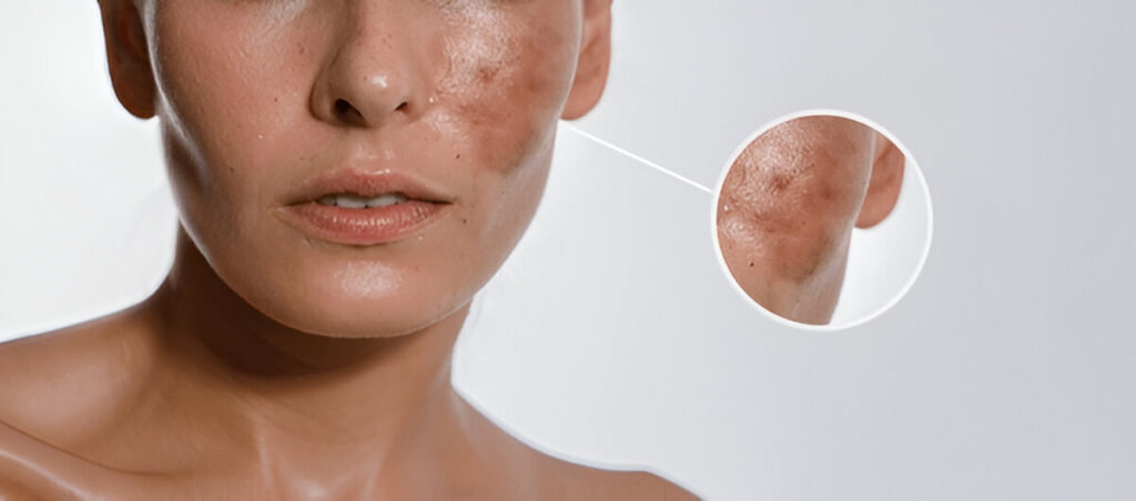 Hyperpigmentation, Chemical Peel Treatment For Hyperpigmentation

