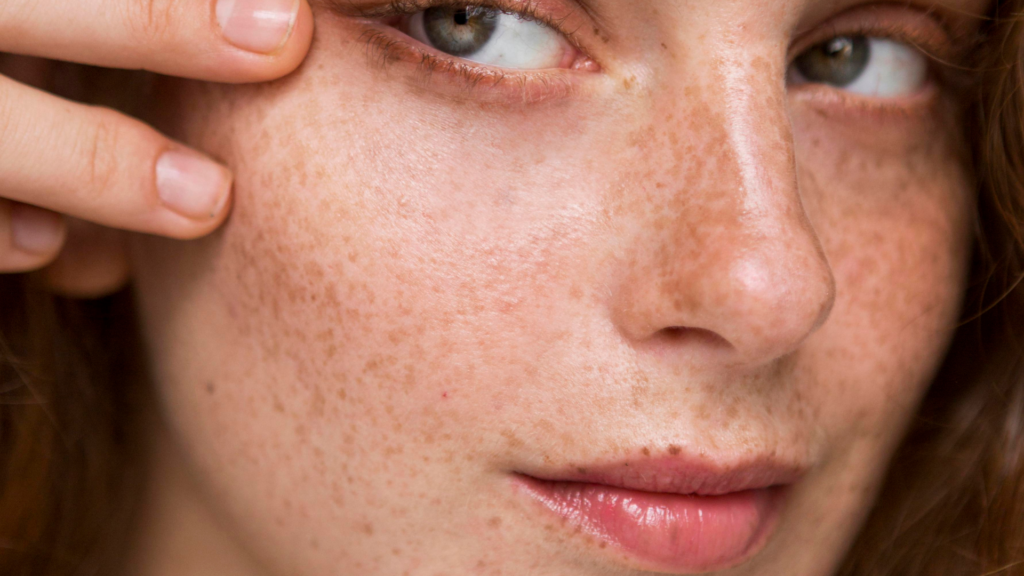 Pigmentation, Can Pigmentation Be Cured Permanently?