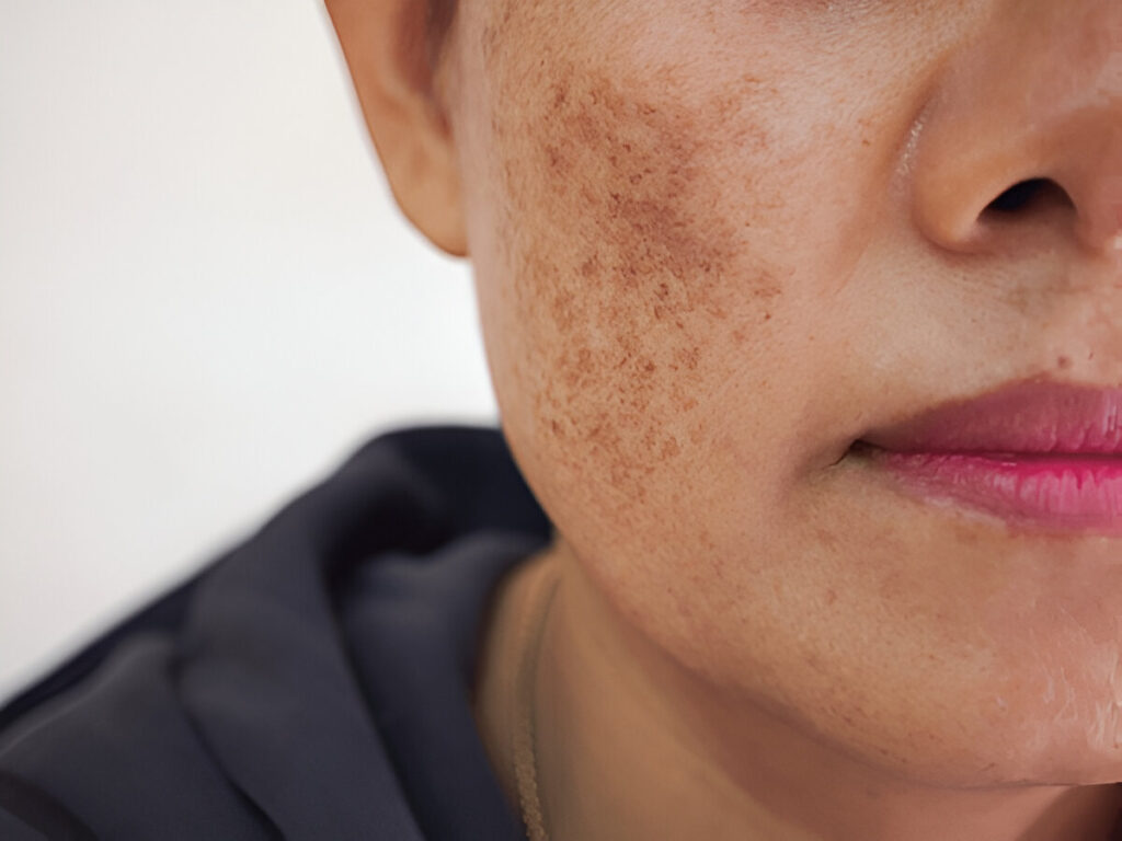 Skin Pigmentation, Can Pigmentation Be Cured Permanently?