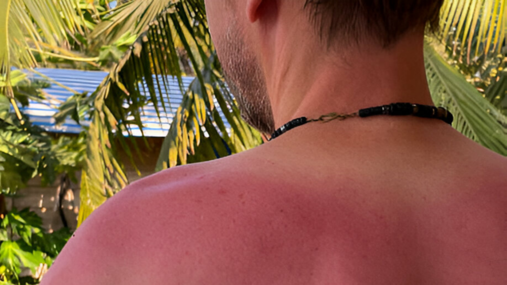 Skin Tan, What is the Reason for Skin Tanning?