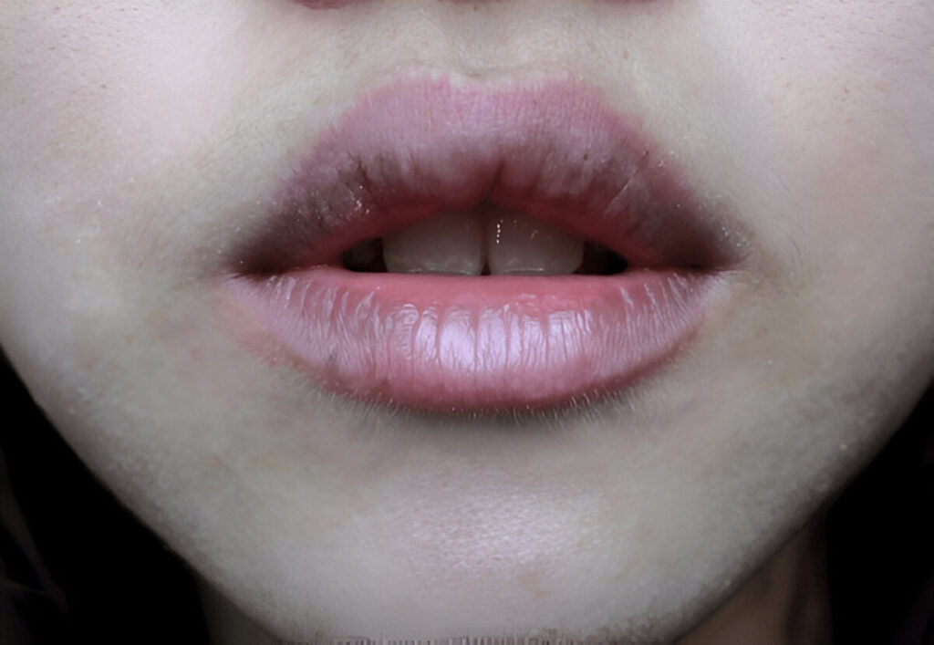 Dark Lips, Chemical Peel for Dark Lips