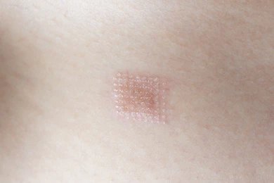 Laser Hair Removal Burns
