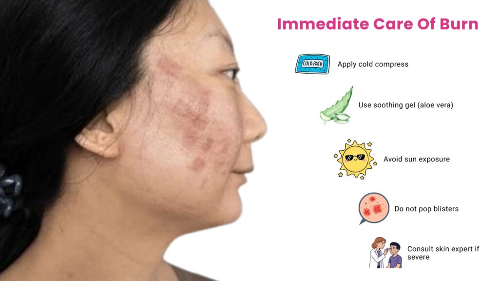 Immediate Care Of Burn