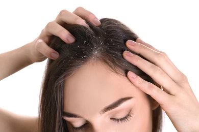 Dandruff on Hair, Can Dandruff Cause Hair Fall?