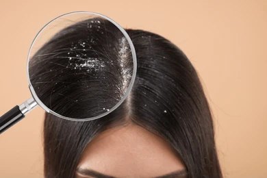 Dandruff, Can Dandruff Cause Hair Fall?