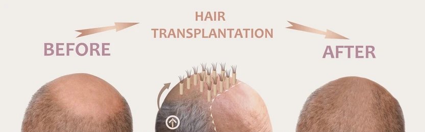 Hair Transplant